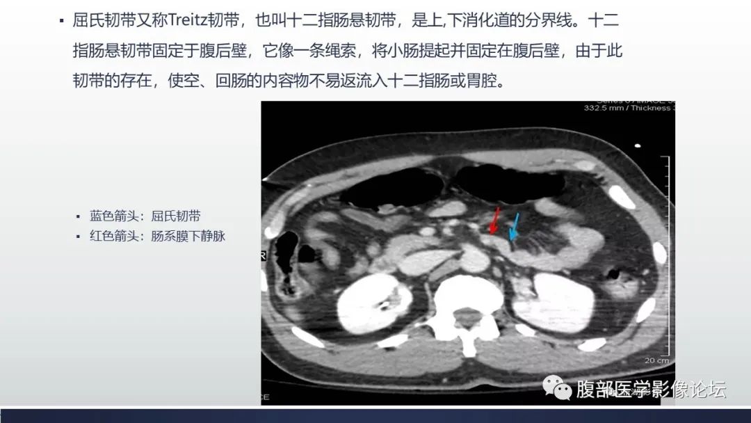 【病例】腹内疝1例CT影像诊断