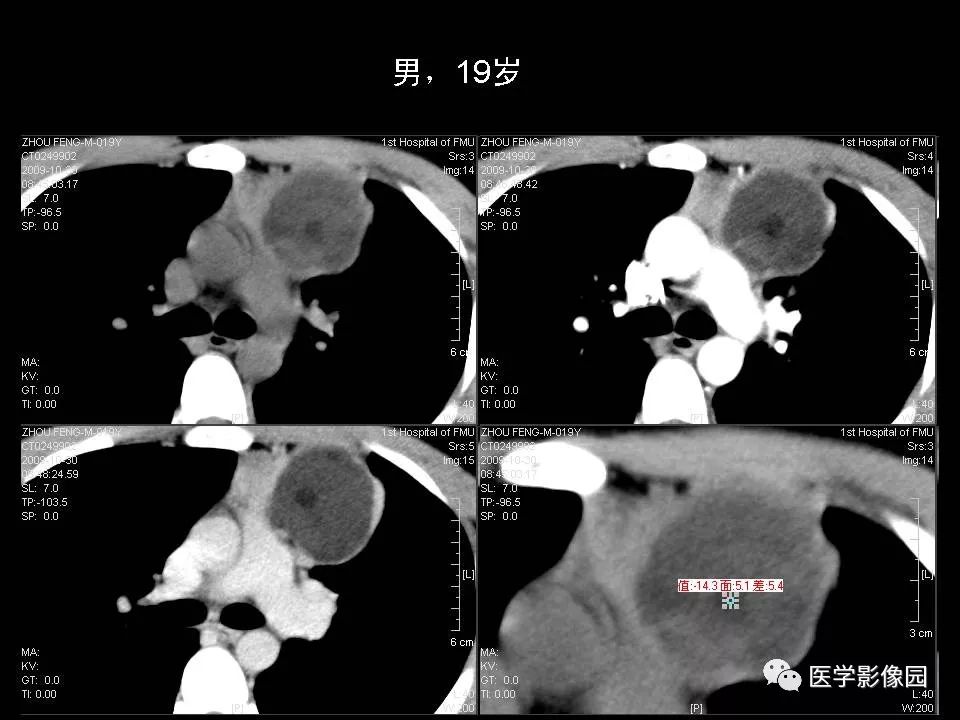 【PPT】胸腺类癌CT诊断与鉴别诊断