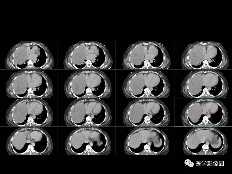 【PPT】胸腺类癌CT诊断与鉴别诊断