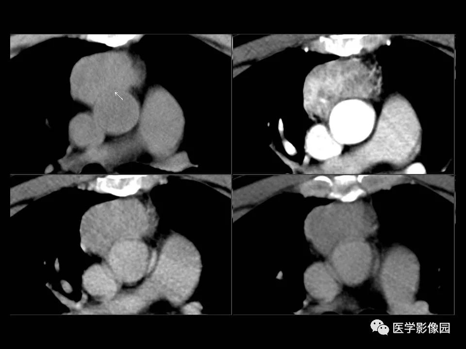 【PPT】胸腺类癌CT诊断与鉴别诊断