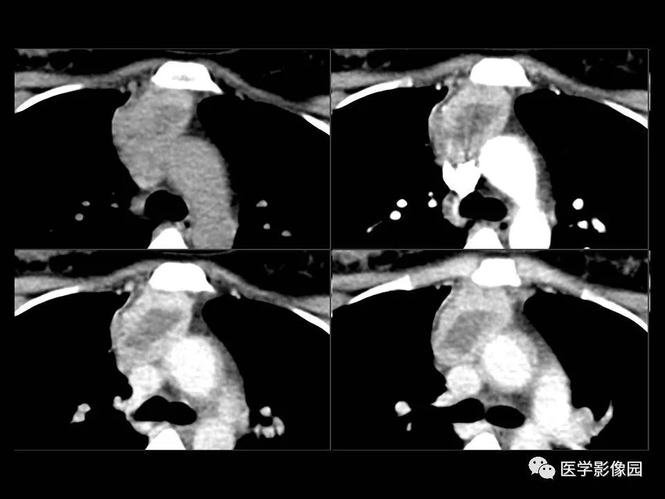 【PPT】胸腺类癌CT诊断与鉴别诊断