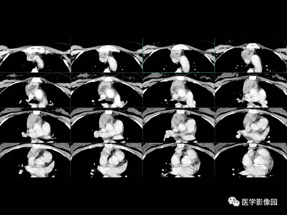 【PPT】胸腺类癌CT诊断与鉴别诊断