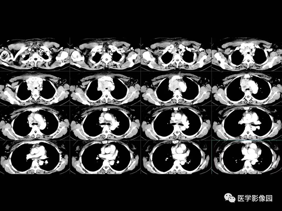 【PPT】胸腺类癌CT诊断与鉴别诊断