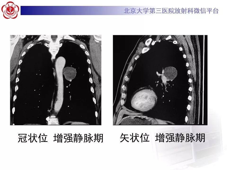 【PPT】肺错构瘤的CT影像
