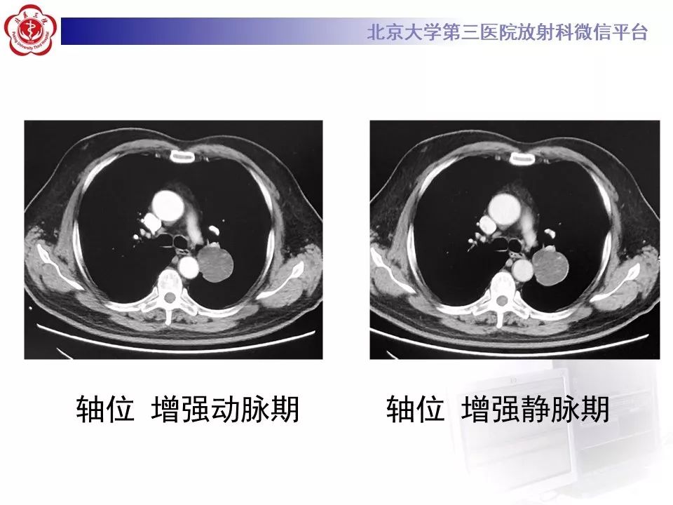 【PPT】肺错构瘤的CT影像