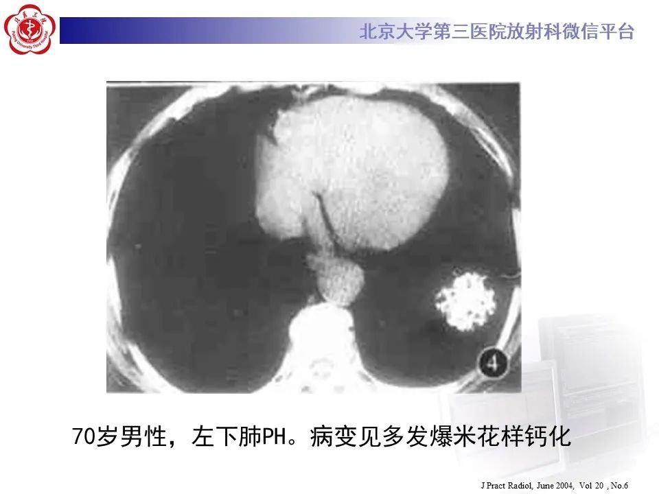 【PPT】肺错构瘤的CT影像