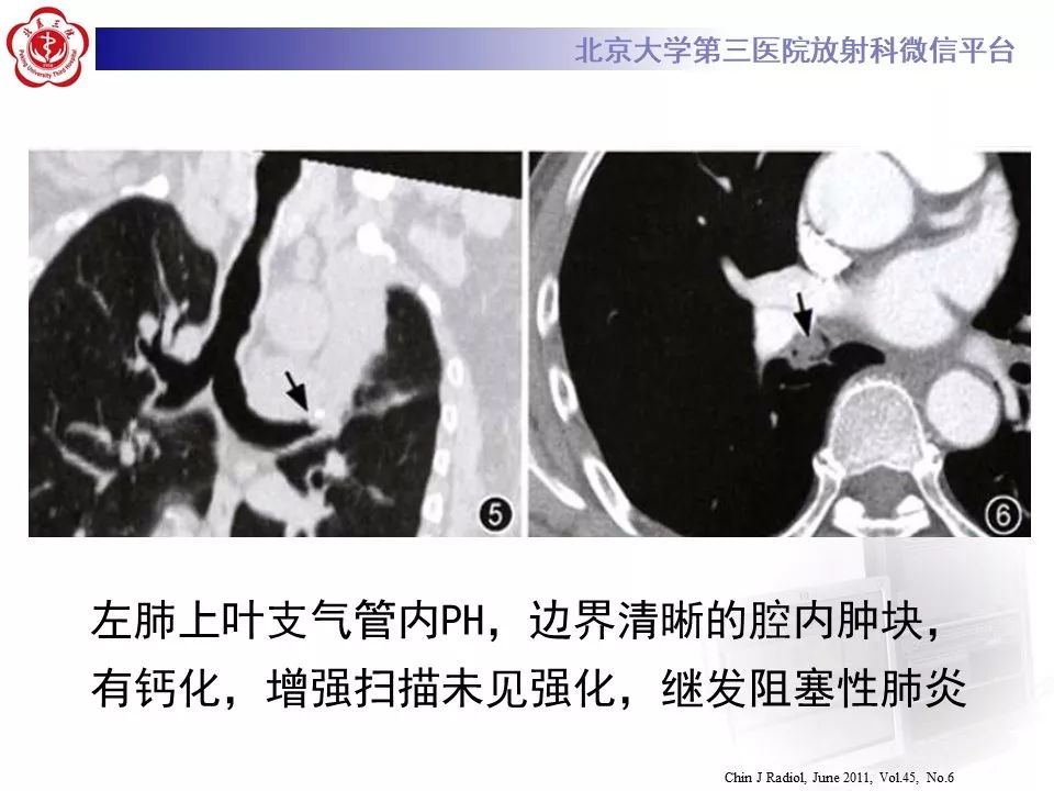 【PPT】肺错构瘤的CT影像