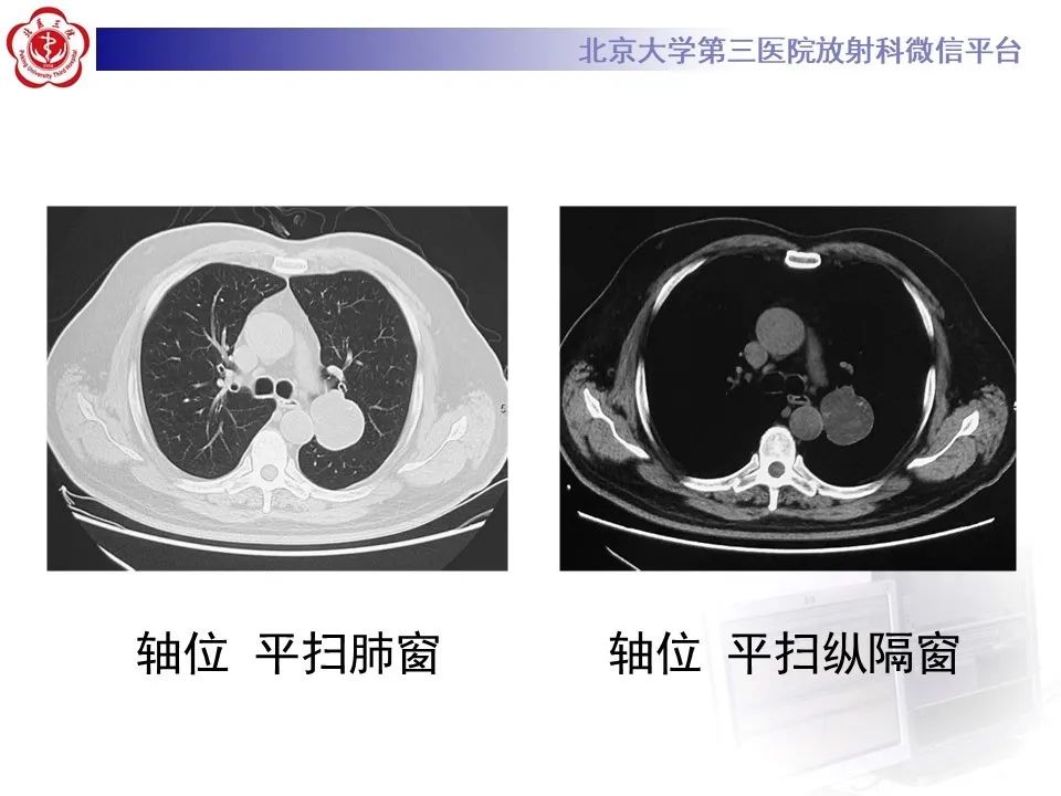 【PPT】肺错构瘤的CT影像