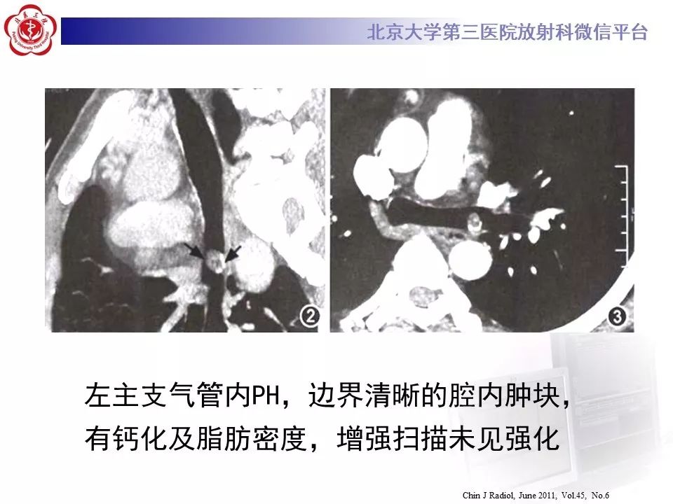【PPT】肺错构瘤的CT影像