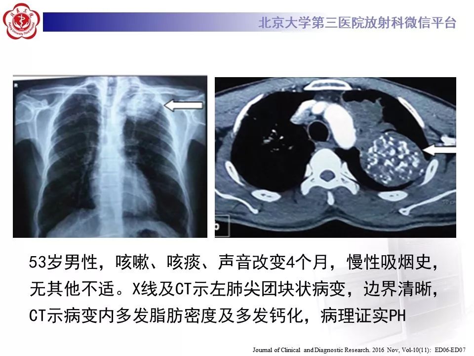 【PPT】肺错构瘤的CT影像