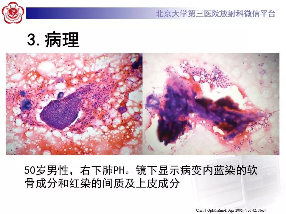 【PPT】肺错构瘤的CT影像