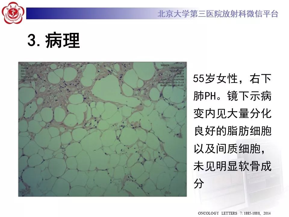 【PPT】肺错构瘤的CT影像