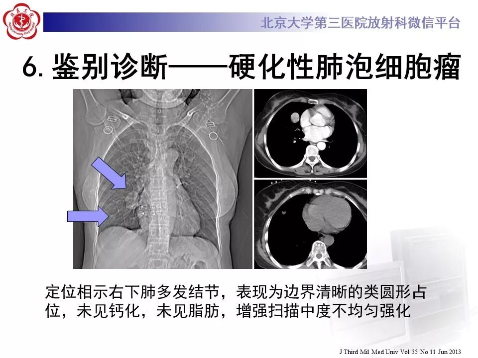 【PPT】肺错构瘤的CT影像