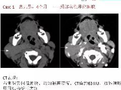 异位胸腺1例CT影像