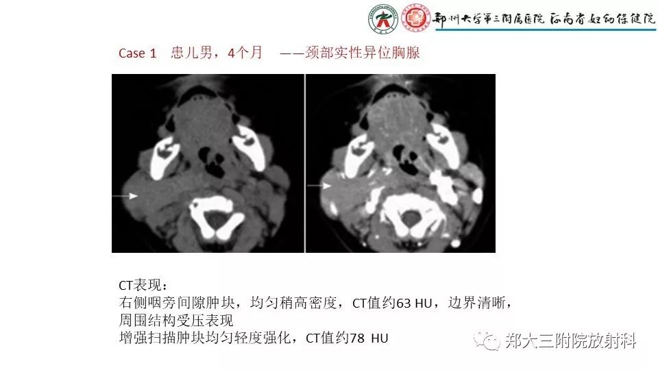 【病例】异位胸腺1例CT影像 【病例】异位胸腺1例CT影像