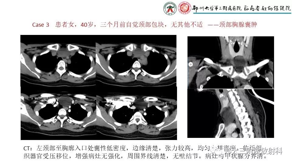 【病例】异位胸腺1例CT影像 【病例】异位胸腺1例CT影像