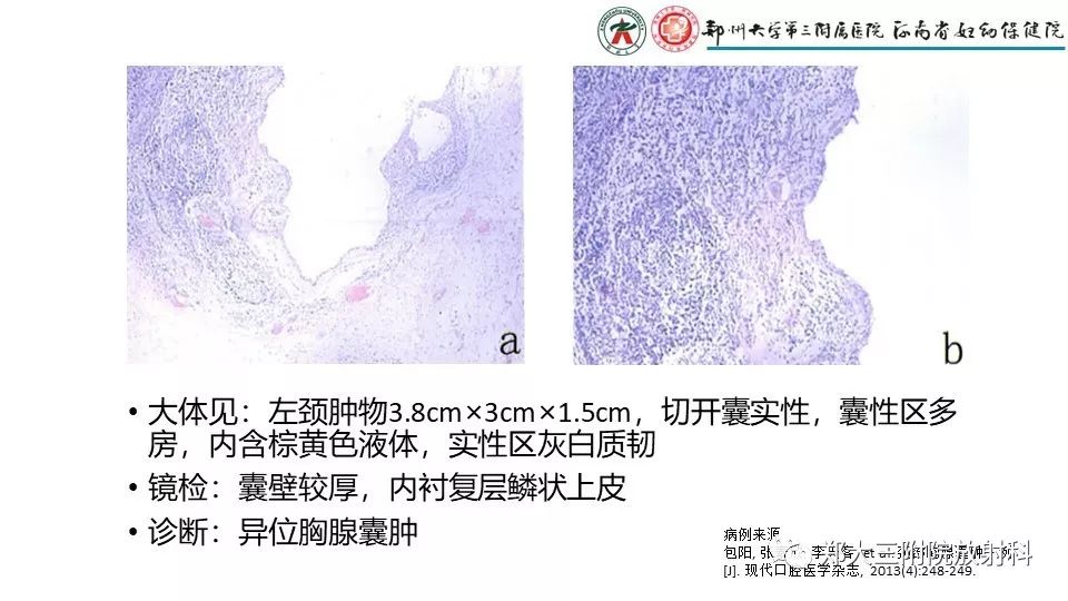 【病例】异位胸腺1例CT影像 【病例】异位胸腺1例CT影像