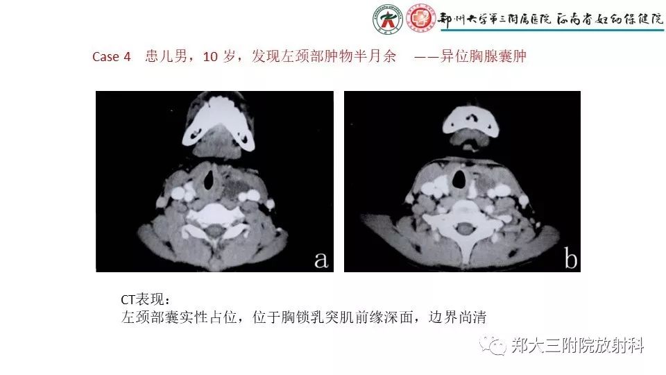 【病例】异位胸腺1例CT影像 【病例】异位胸腺1例CT影像