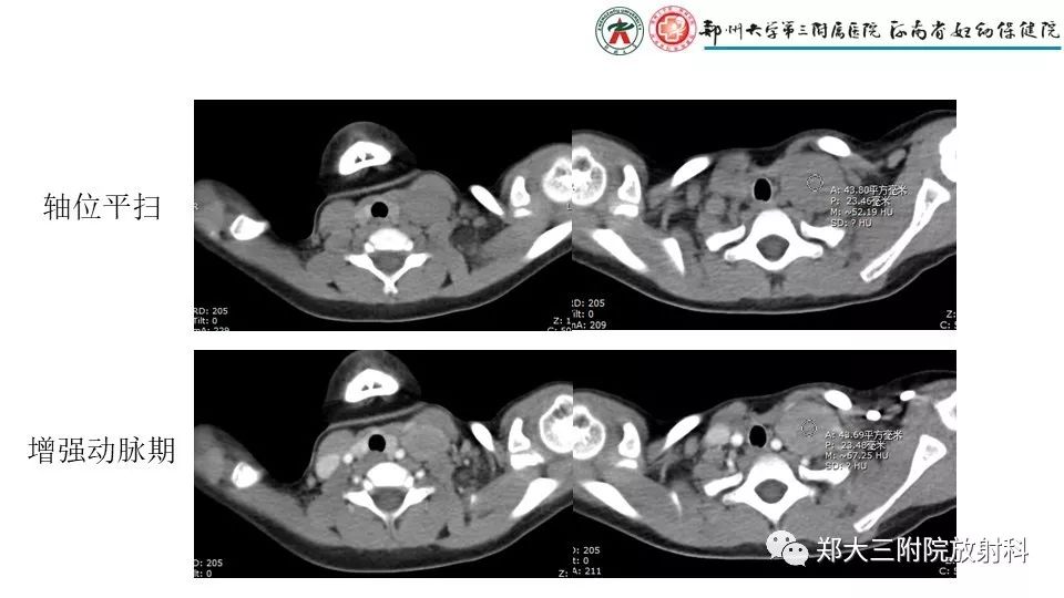 【病例】异位胸腺1例CT影像