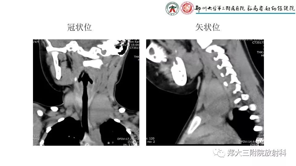【病例】异位胸腺1例CT影像