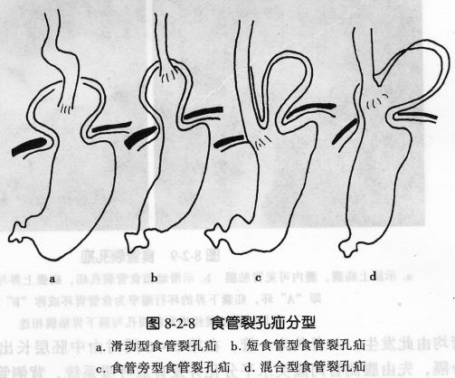 食管疾病的X线造影
