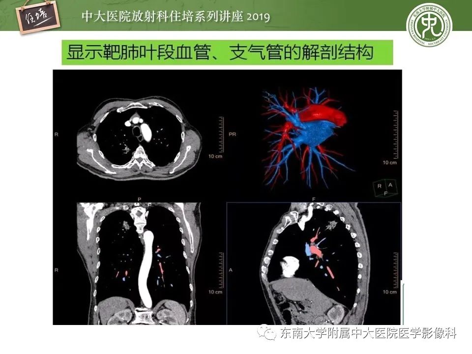 【PPT】肺结节的影像诊断及临床管理