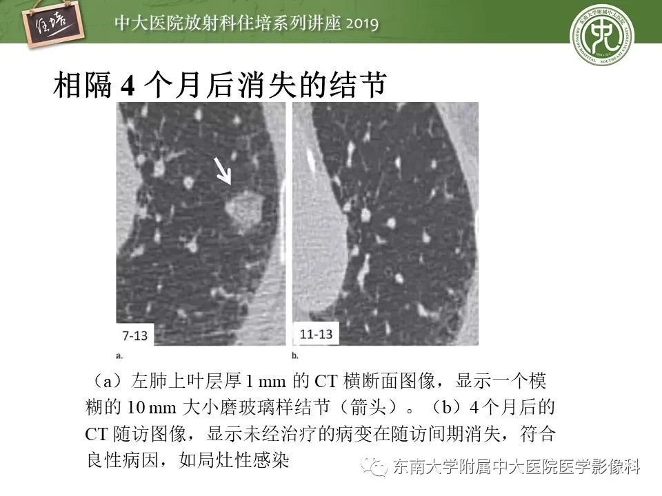【PPT】肺结节的影像诊断及临床管理