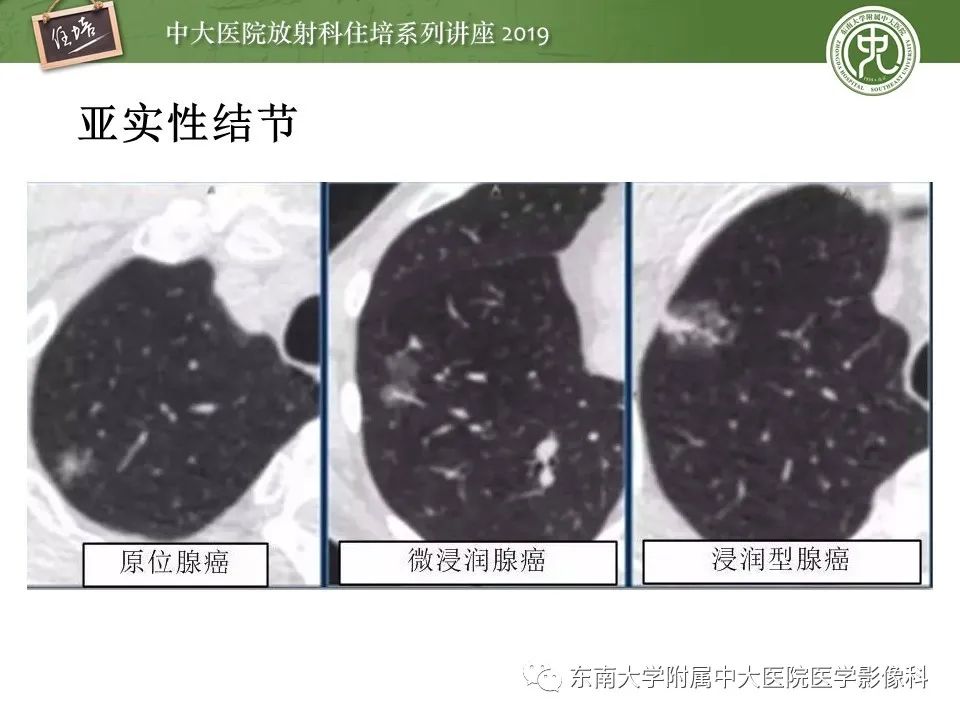 【PPT】肺结节的影像诊断及临床管理