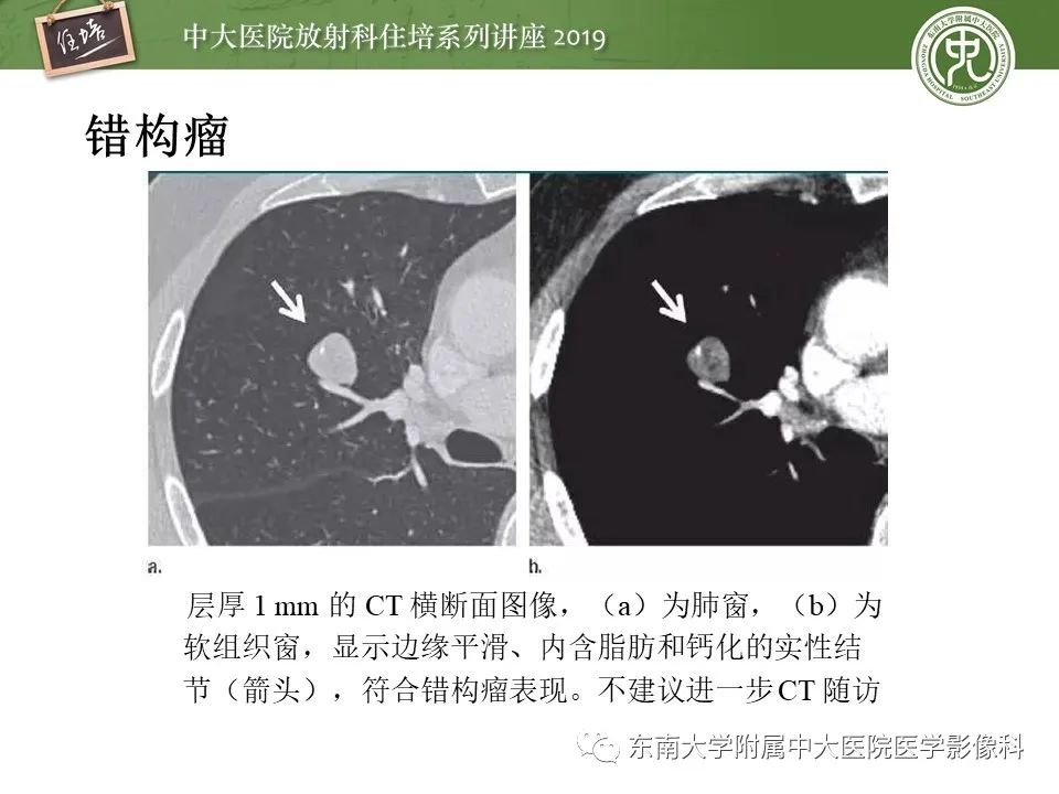 【PPT】肺结节的影像诊断及临床管理