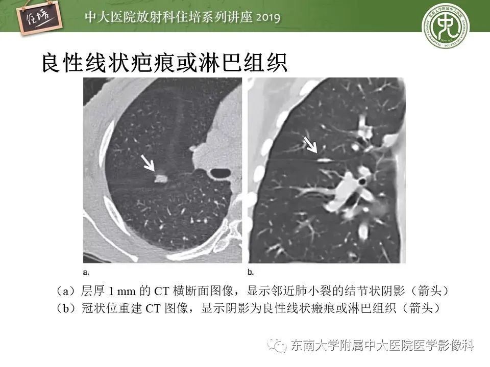 【PPT】肺结节的影像诊断及临床管理