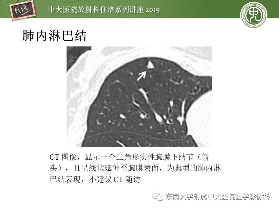 【PPT】肺结节的影像诊断及临床管理