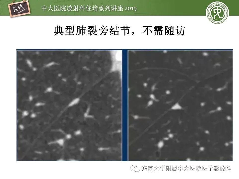 【PPT】肺结节的影像诊断及临床管理