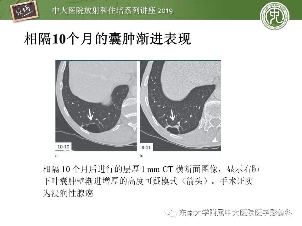 【PPT】肺结节的影像诊断及临床管理