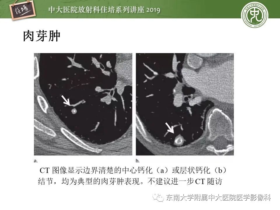 【PPT】肺结节的影像诊断及临床管理