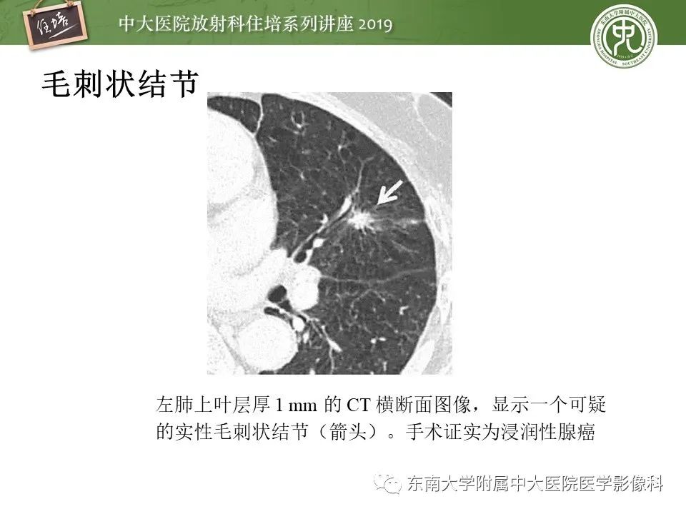 【PPT】肺结节的影像诊断及临床管理