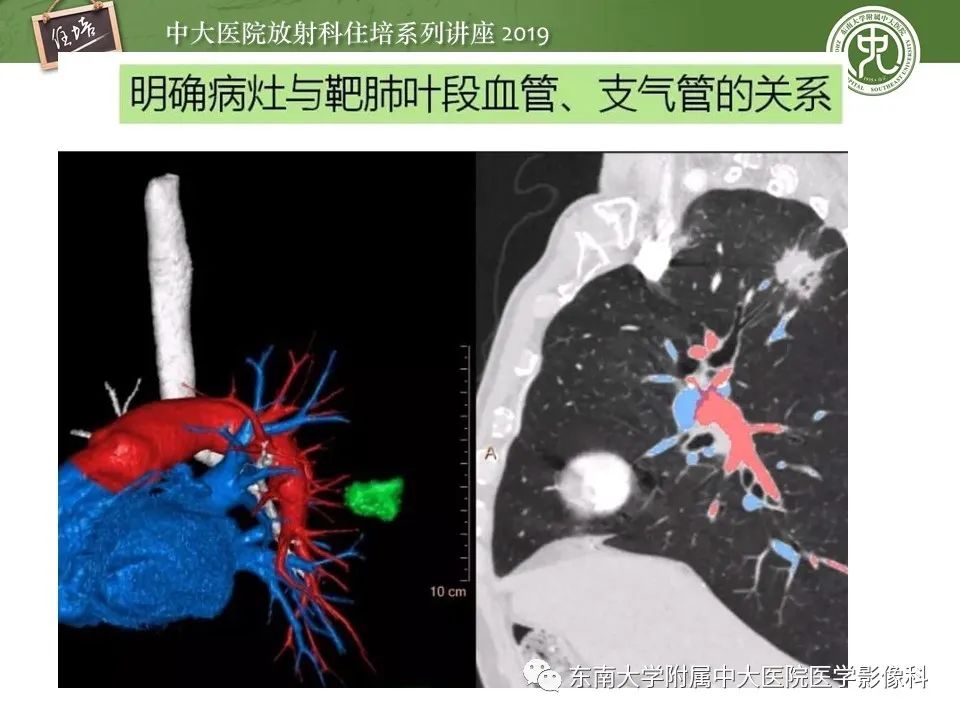 【PPT】肺结节的影像诊断及临床管理