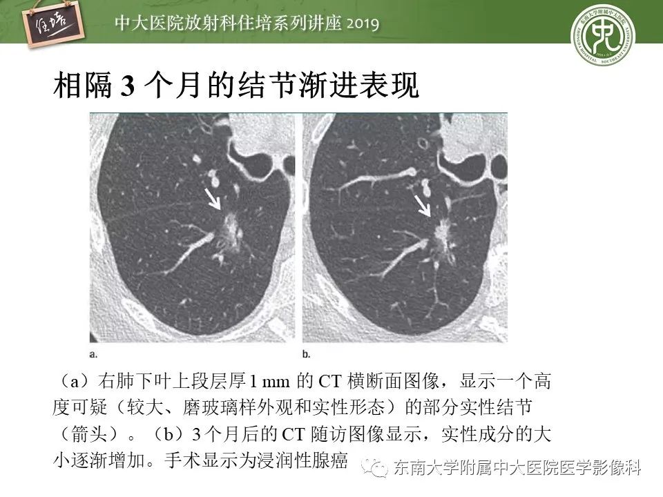 【PPT】肺结节的影像诊断及临床管理