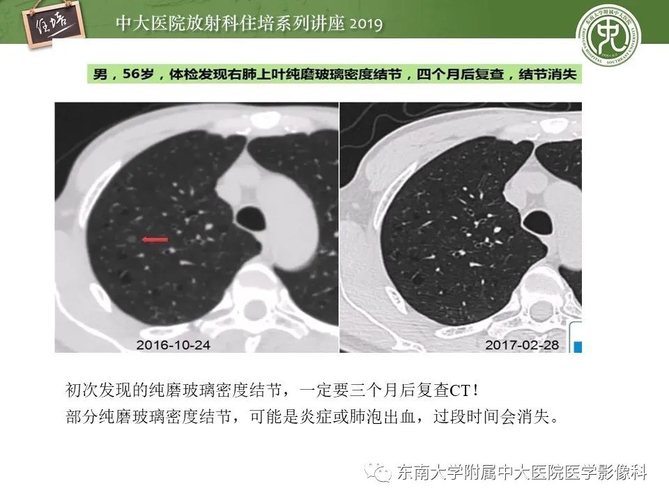 【PPT】肺结节的影像诊断及临床管理