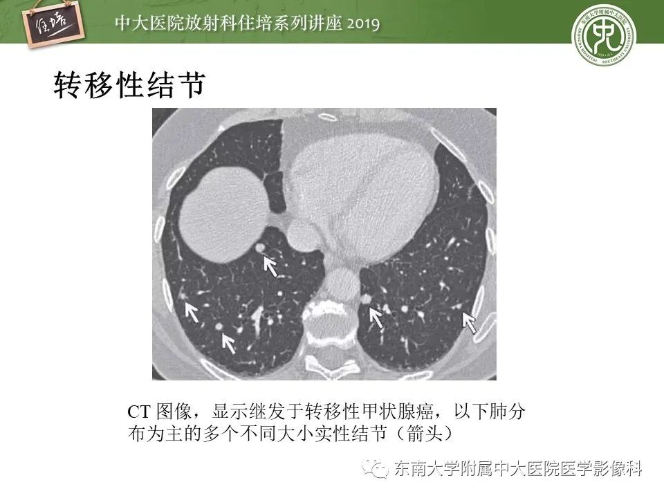 【PPT】肺结节的影像诊断及临床管理