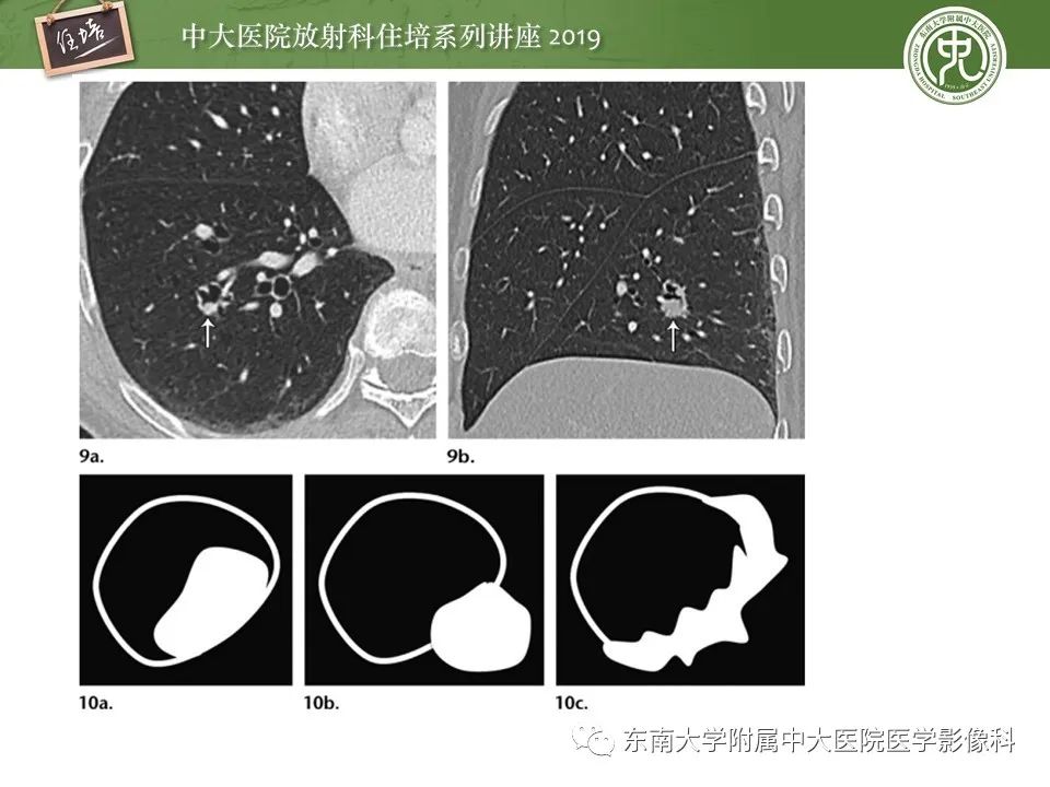 【PPT】肺结节的影像诊断及临床管理