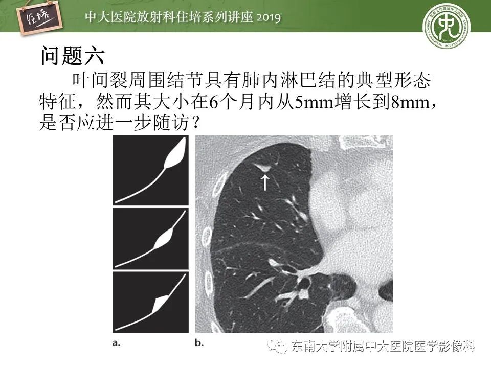 【PPT】肺结节的影像诊断及临床管理