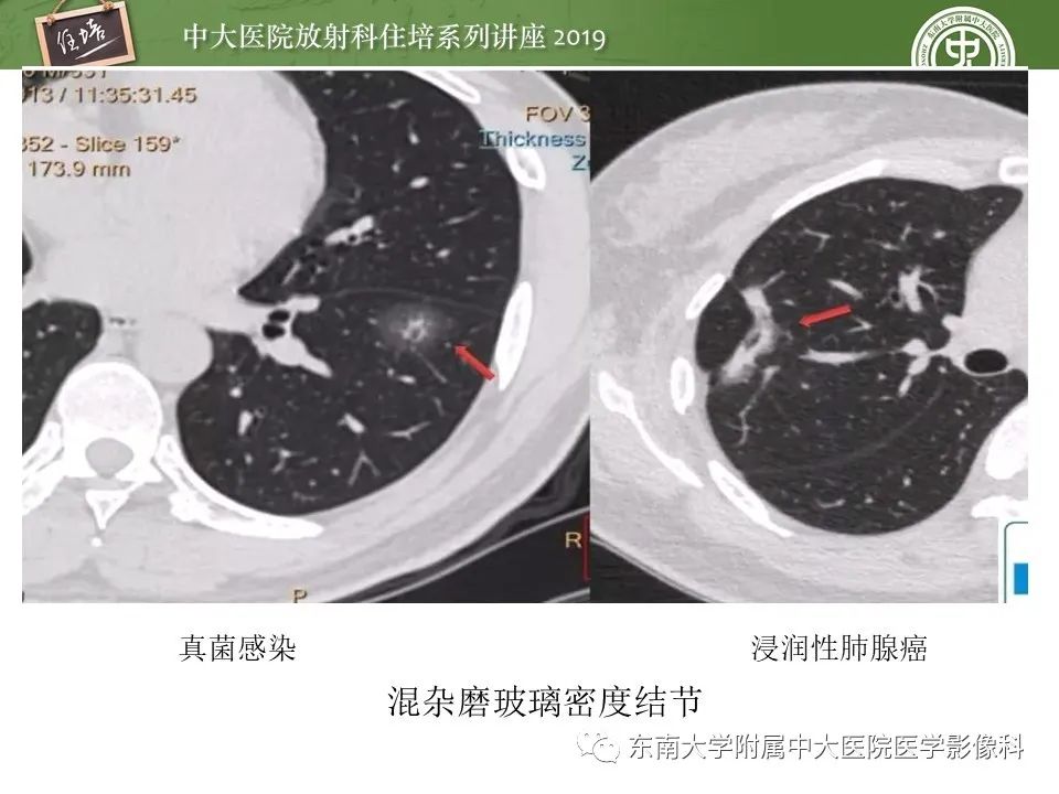 【PPT】肺结节的影像诊断及临床管理