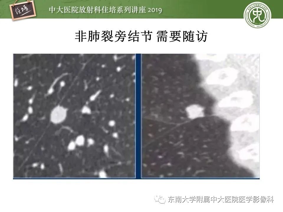 【PPT】肺结节的影像诊断及临床管理