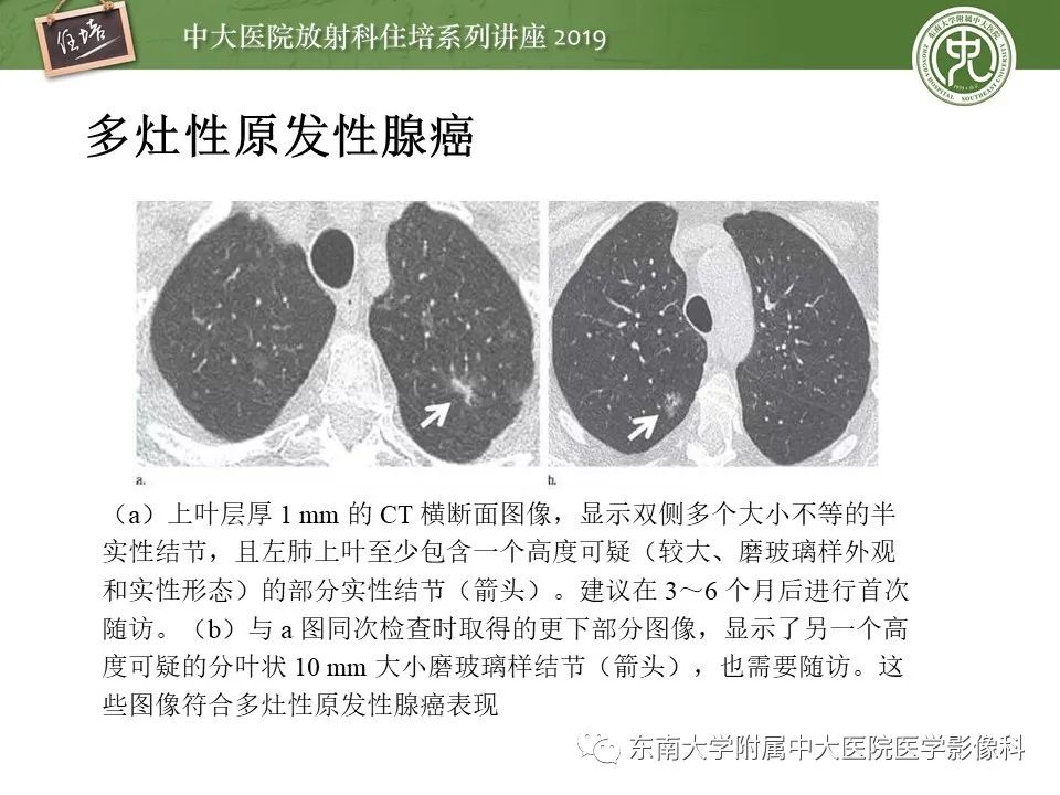 【PPT】肺结节的影像诊断及临床管理