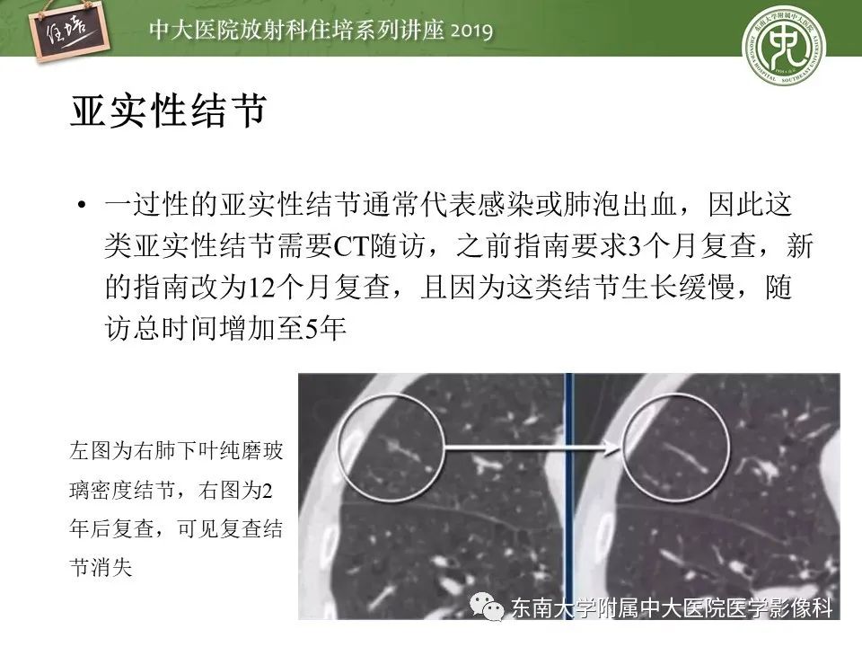 【PPT】肺结节的影像诊断及临床管理