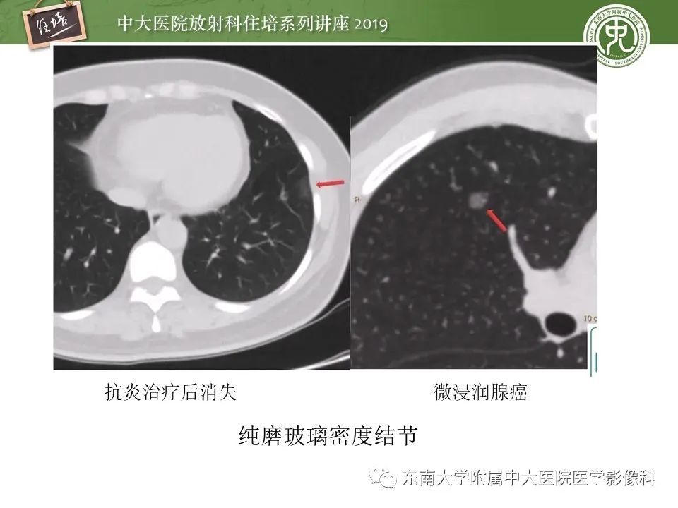 【PPT】肺结节的影像诊断及临床管理