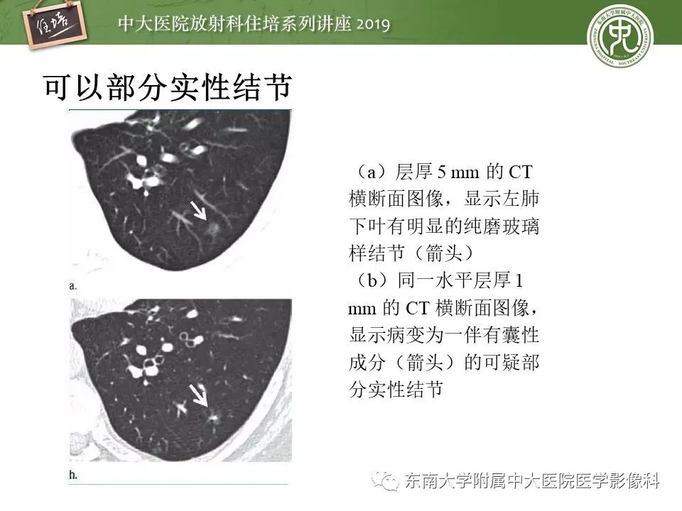 【PPT】肺结节的影像诊断及临床管理