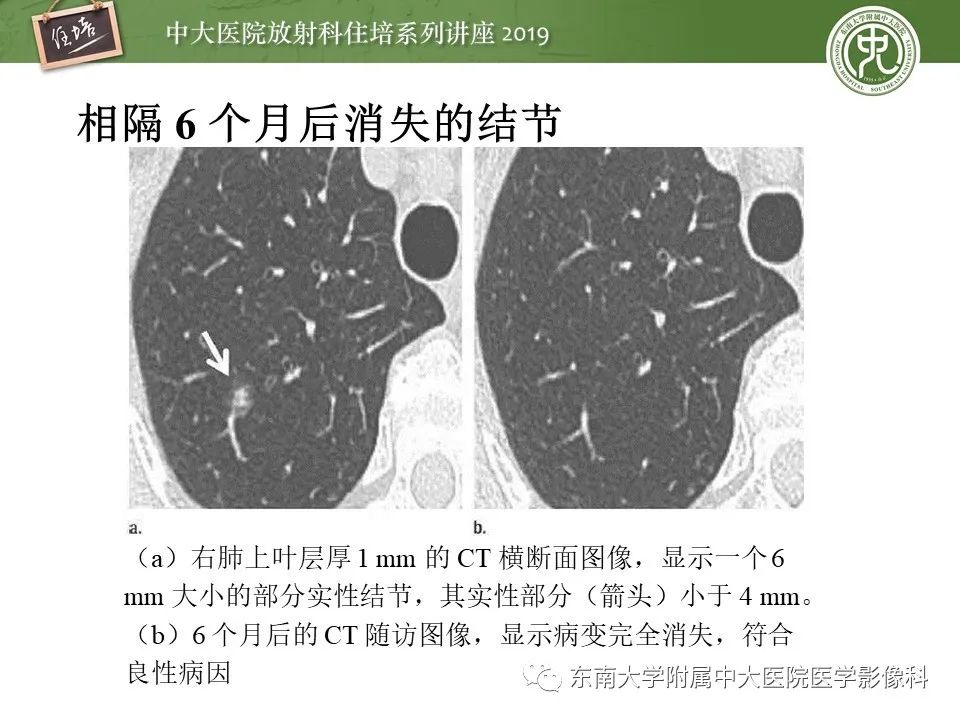 【PPT】肺结节的影像诊断及临床管理