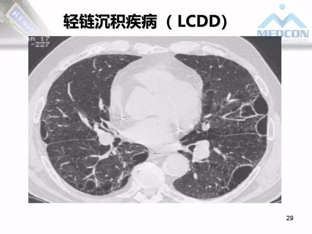 【PPT】肺气肿、囊性肺部疾病的影像学病因鉴别