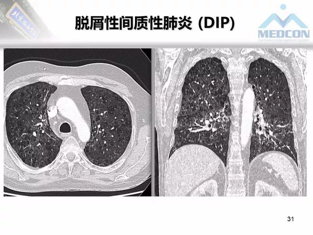 【PPT】肺气肿、囊性肺部疾病的影像学病因鉴别